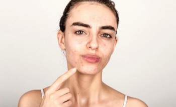 Acne scars